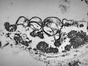 M, | newborn heart … mitochondrial cardiomyopathy … reduced mitochondrial cristae … autopsy sample